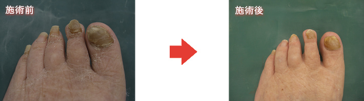 フットケア